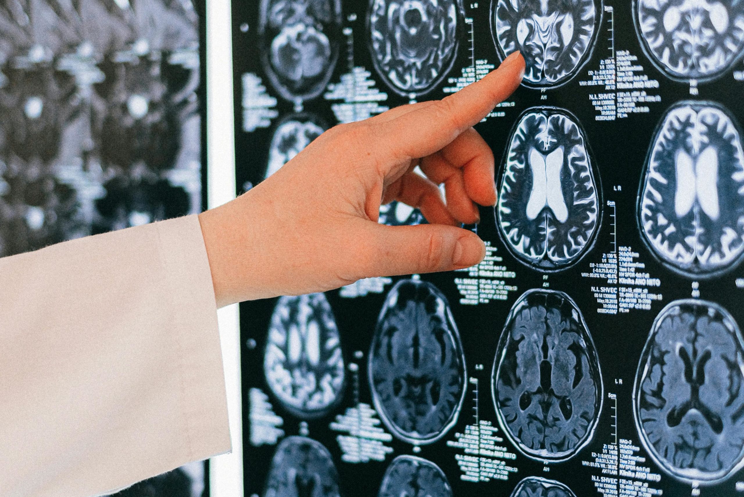 Alcohol and Memory Loss